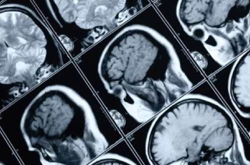 tomografia cerebral un estudio de imagen
